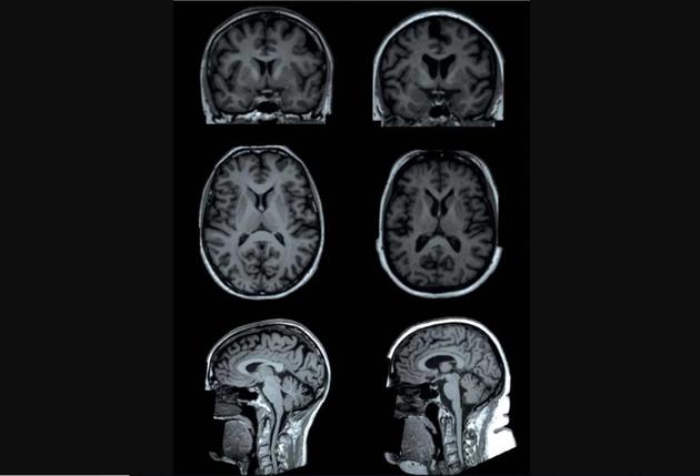 一項(xiàng)最新研究發(fā)現(xiàn)，體脂越高，大腦某些區(qū)域容量就越小。上圖為研究中兩名測(cè)試者(年齡均為65歲的女性)的大腦核磁共振掃描。一名測(cè)試者(左側(cè)圖)體脂為13%，另一名測(cè)試者(右側(cè)圖)體脂為49%。核磁共振掃描顯示，與左圖測(cè)試者相比，右圖測(cè)試者大腦某些區(qū)域(“皮質(zhì)下區(qū)域”)灰質(zhì)容量較低。