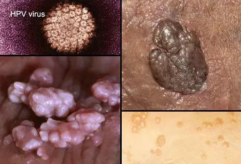  人乳頭瘤病毒的電鏡照片以及導(dǎo)致皮膚疾病癥狀（圖片來(lái)源：中國(guó)科學(xué)院微生物研究所）